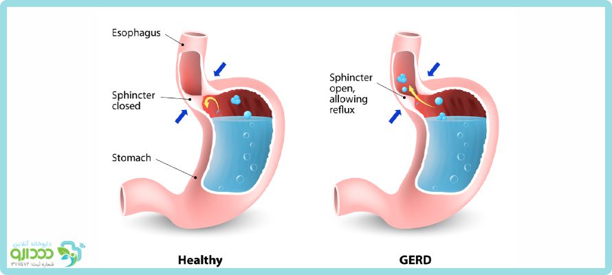 رفلاکس اسید معده