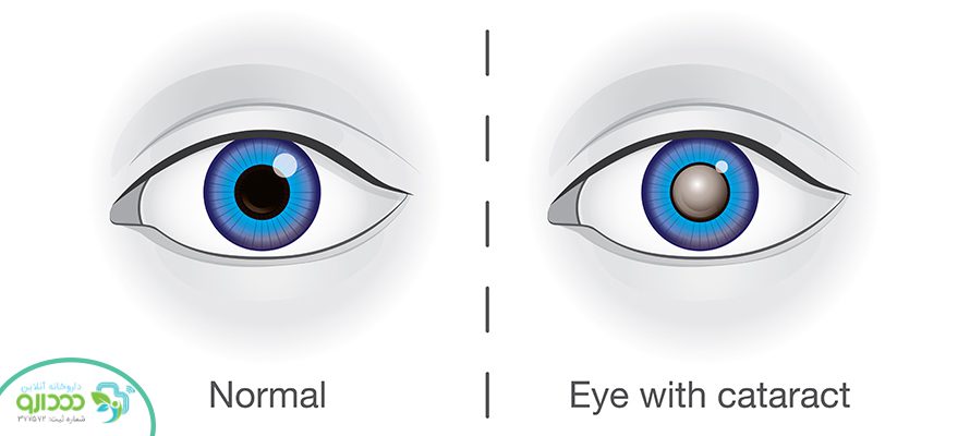 مقایسه چشم طبیعی با چشم مبتلا به کاتاراکت