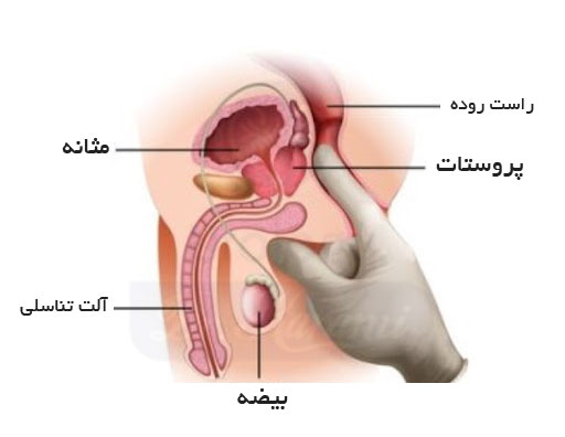 درمان پروستات