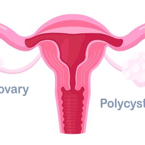 سندروم پلی‌ کیستیک تخمدان PCO