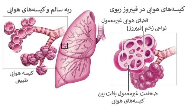 فیبروز ریوی چیست