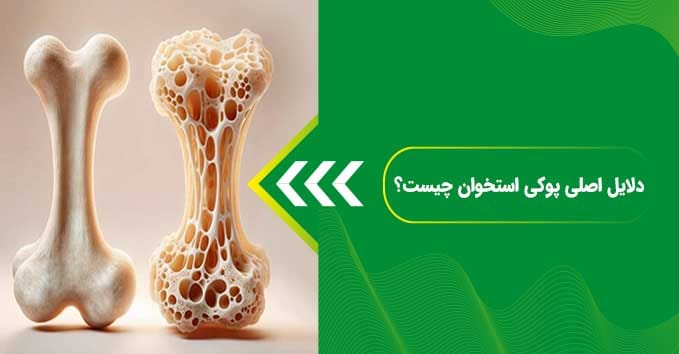 پوکی استخوان