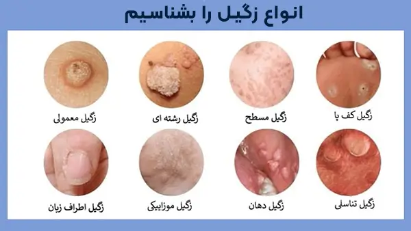 زگیل تناسلی بیماری خاموش