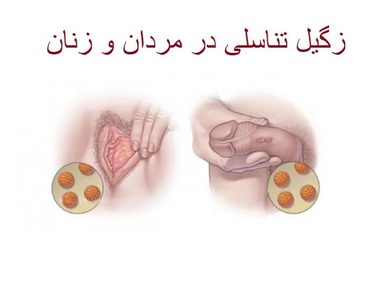 زگیل تناسلی بیماری خاموش