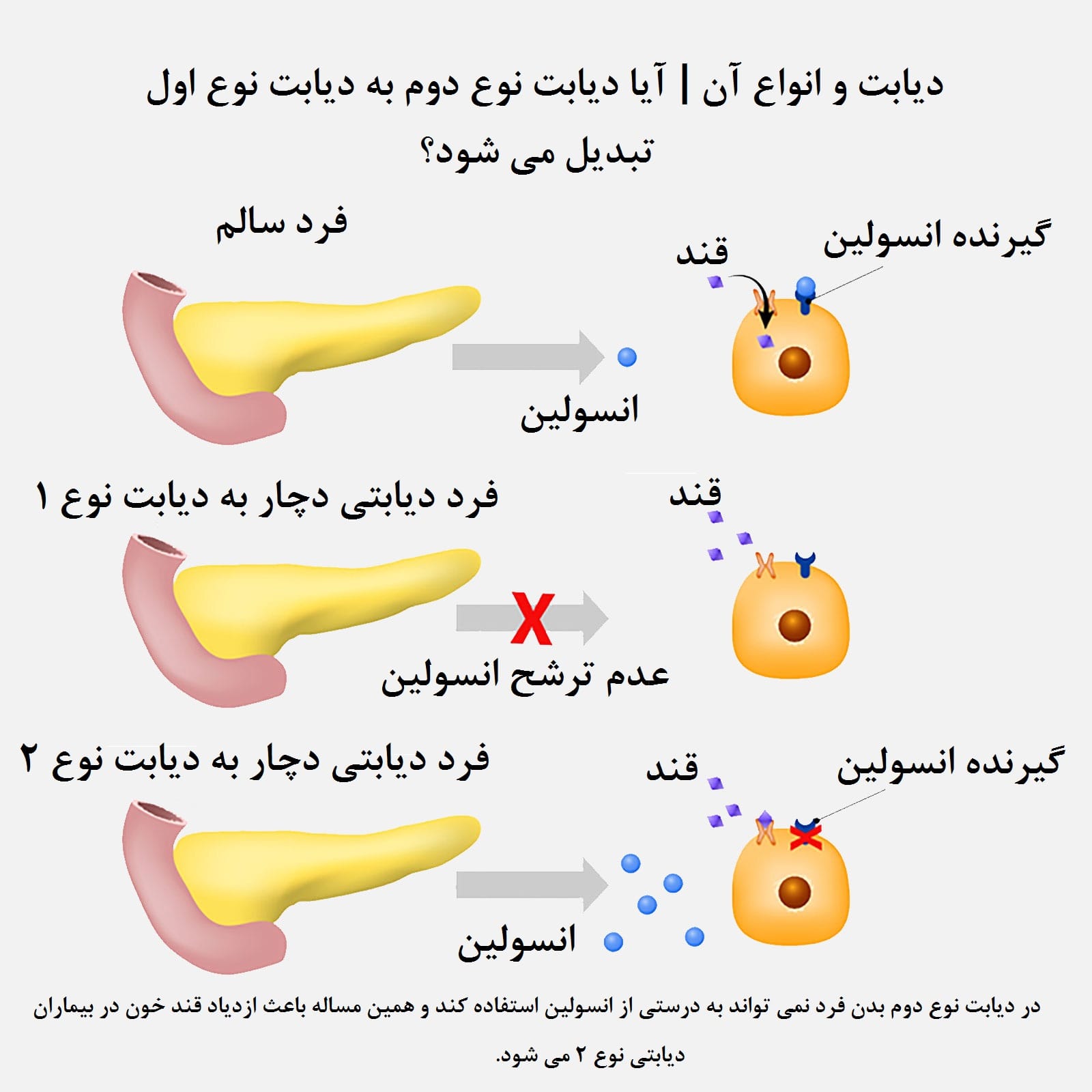 دیابت نوع ۲
