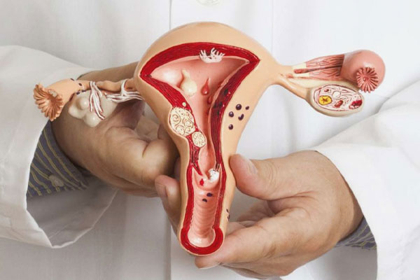 کیست تخمدان چیست؟