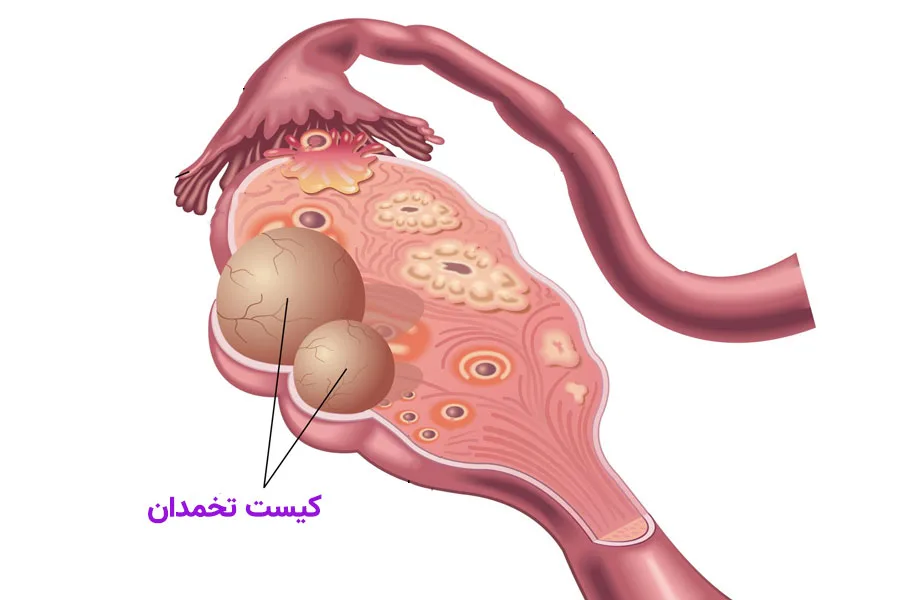 کیست تخمدان چیست؟