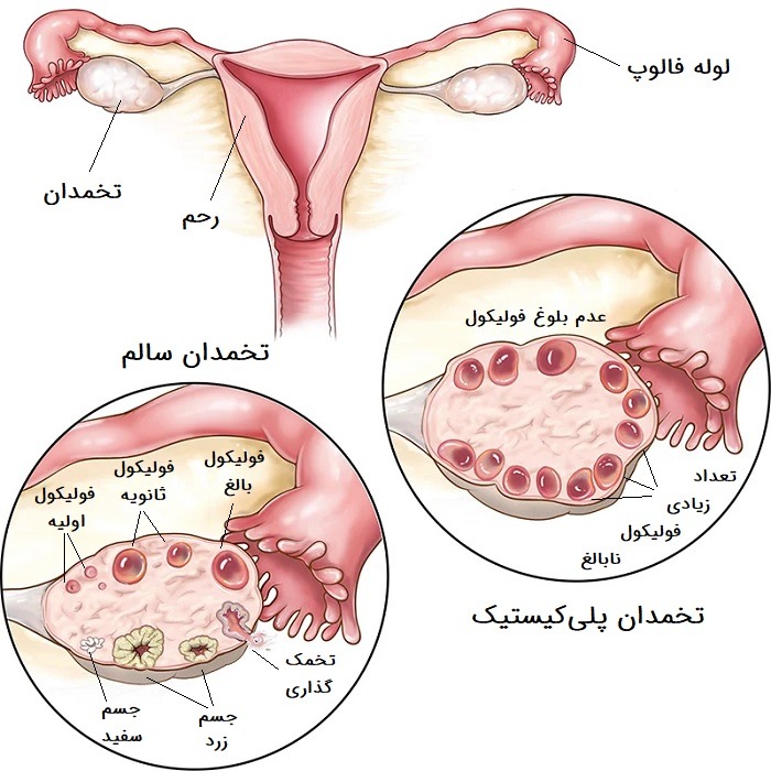 کیست تخمدان چیست؟