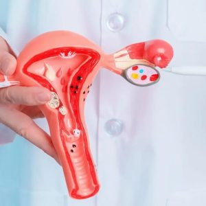 کیست تخمدان چیست؟