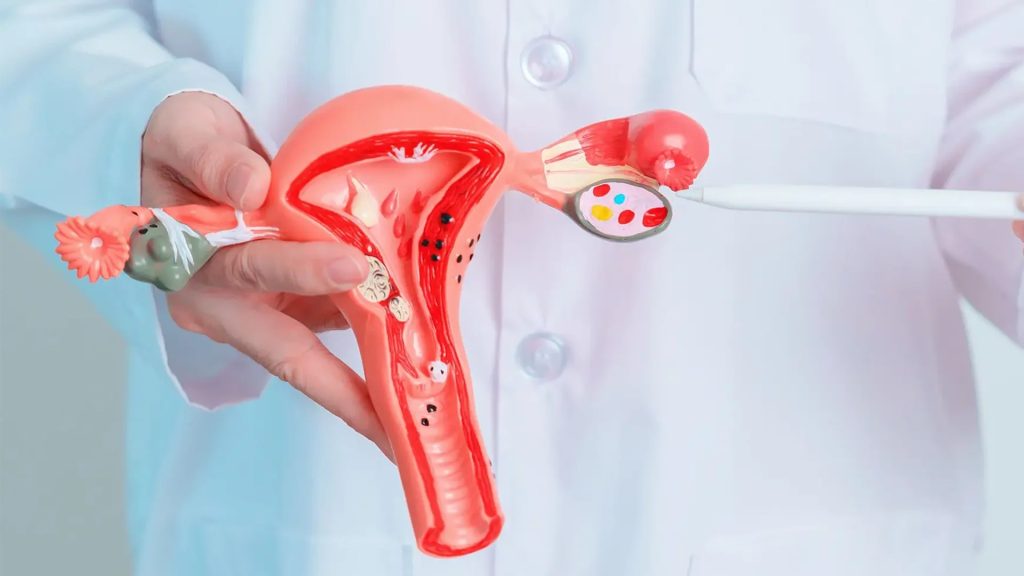 کیست تخمدان چیست؟